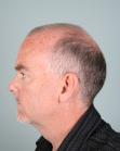 Before Hair Transplant&nbsp;2 Sessions (Areas)